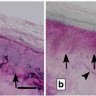 Small Nerve Fiber Screening List