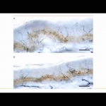 Small Fiber Neuropathy Presentation Todd Levine MD - YouTube