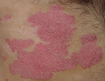 Psoriasis_plaque_closeup.jpg