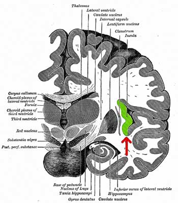 The Lyrica Effect: Lyrica Study Uncovers Key Brain Abnormalities in Fibromyalgia