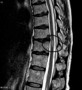 Transverse myelitis MRI