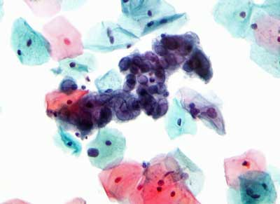 Herpes simplex virus