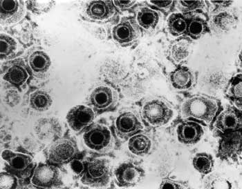 herpes simplex