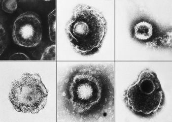 herpes simplex