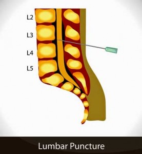 lumbar puncture