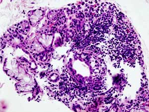 SS biopsy