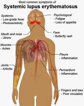 symptoms-SLE