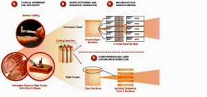 INTiDYN's sophisticated analyses found ten times the normal levels of  nerve fibers  in the hands of most  FM patients