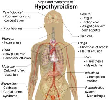 hypothyroidism