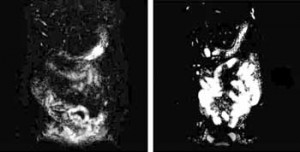 MRI