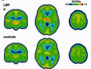 microglial activation pain