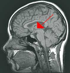 thalamus chronic fatigue syndrome