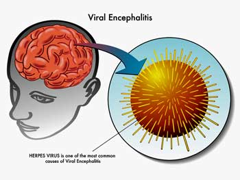 “An Immune Mediated Brain Disorder”: Mady Hornig and Llewellyn Kin