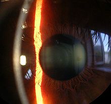 cornea fibromyalgia