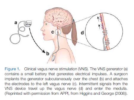 "Reborn" - Reversing Fibromyalgia with Vagus Nerve Stimulation - Health