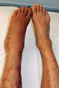 CRPS