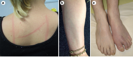 neurogenic inflammation fibromyalgia