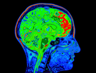 central nervous system fibromyalgia