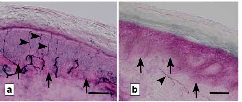 Diagnosing Fibromyalgia The Small Nerve Fiber Way