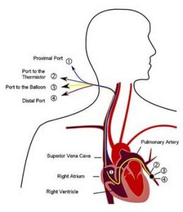 pulmonary catheter