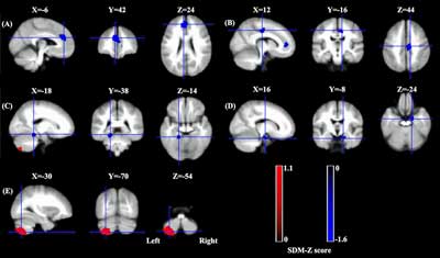fibromyalgia brain scan results