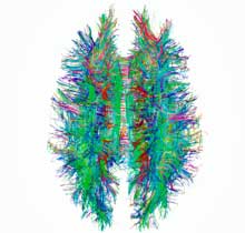 white matter brain me/cfs