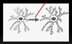 microglia activation in fibromyalgia