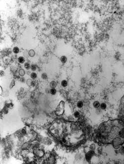 mononucleosis