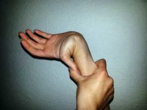 Thumb hyper-extension in EDS