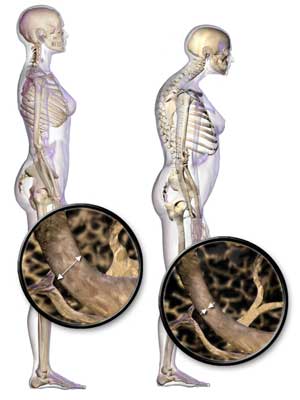 Bones Pt II: Chronic Fatigue Syndrome (ME/CFS), Fibromyalgia, Osteoporosis and Getting Older