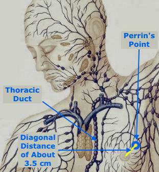Toxic Brains, Frozen Spines and the Perrin Point: Ray Perrin, ME/CFS and Fibromyalgia