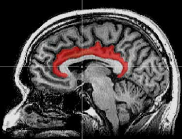 The cingulate cortex - which Younger called the "seat of suffering" was particularly inflamed