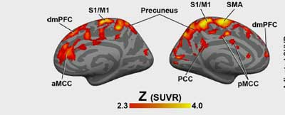 Neuroinflammation fibromyalgia