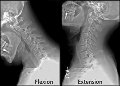 cervical instability cauzelor răni ale articulațiilor