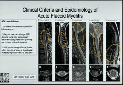 lipkin acute flaccid myelitis