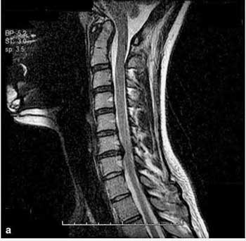 Spinal stenosis ME-CFS