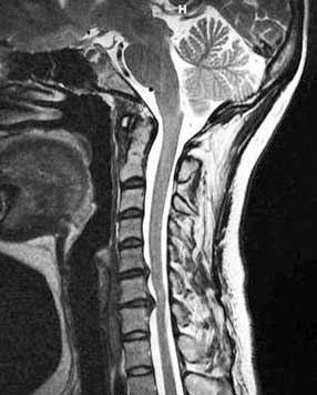 Rowe - spinal stenosis