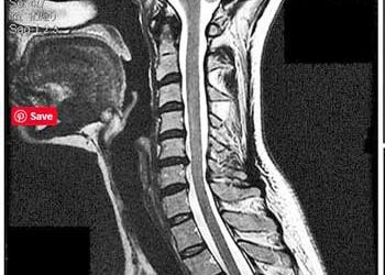 Spinal stenosis - Rowe