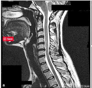 Spinal stenosis - Rowe