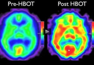 SPECT scan