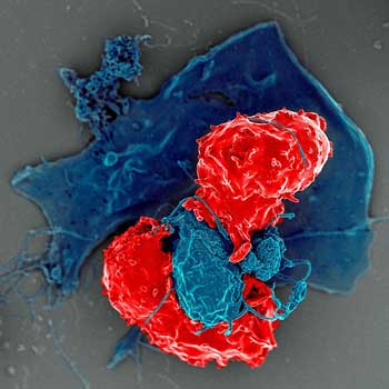 A Never-Ending Immune Battle in ME/CFS? The Regulatory T-cell/Herpesvirus Hypothesis
