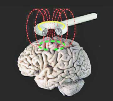Transcranial Magnetic Stimulation (TMS) Fibromyalgia Study Produces Lasting Relief
