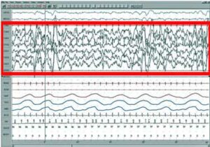 The Sleep Issues in Fibromyalgia: an Overview - Pt. 3 of Health Rising ...