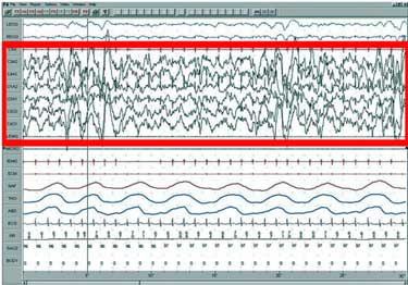 Slow wave sleep