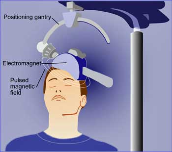 Novel Chronic Fatigue Syndrome (ME/CFS) Brain Stimulation Clinical Trial Begins