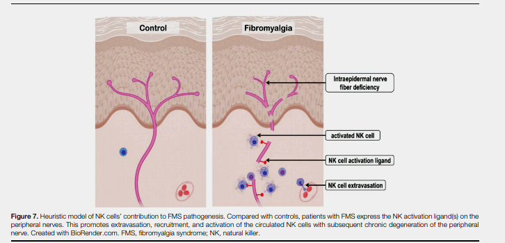 NK Cells small fiber neuropathy - fibromyalgia