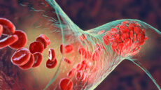 platelet activation clots ME/CFS