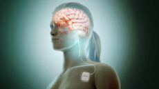 Vagus nerve stimulation