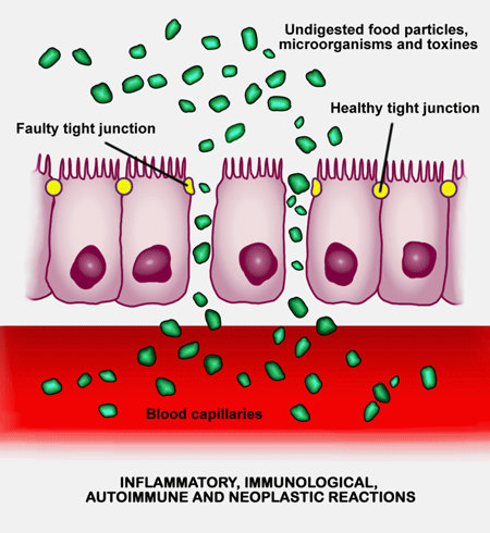 Intestinal permeability ME/CFS, FM and Long COVID