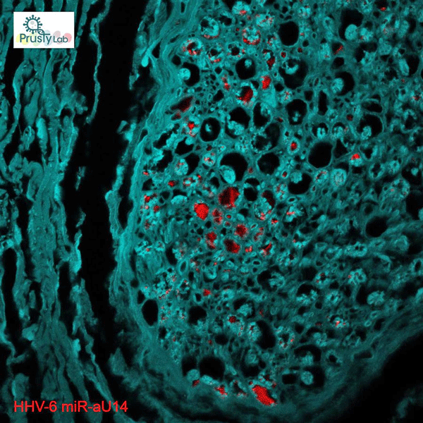 The Prusty Files: HHV-6 Found in the Brains of ME/CFS Patients